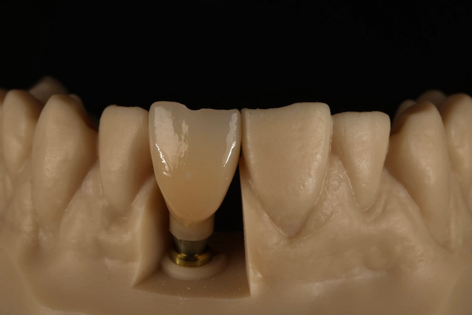 Dental Implant 7